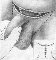 Surgical lengthening of the penis by extracting its hidden part